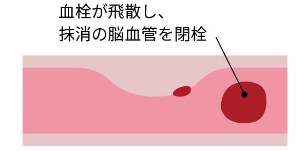 血栓性の機序